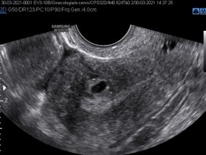 Hysteroscopy SIG Most Difficult Case: Cystic Adenomyosis - NewsScope